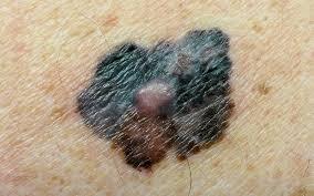 Melanoma