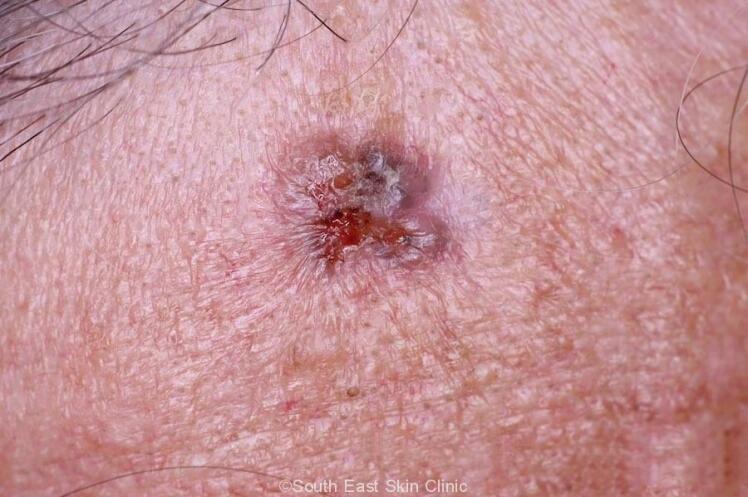 پیشگیری از سرطان پوست