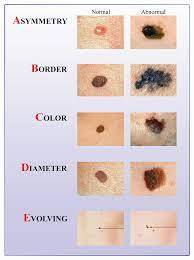 Melanoma